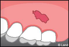 Chirurgie mucogingivale