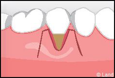 Chirurgie mucogingivale